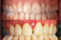 Gum Bleeding Treatment in Dubai