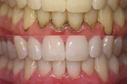 Gum Bleeding Treatment