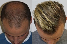 Hair Loss & Nail Disorders Treatment Abu Dhabi