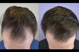 Hair Loss & Nail Disorders Treatment Dubai