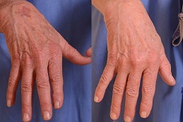 Hand Wrinkles Treatment Dubai UAE