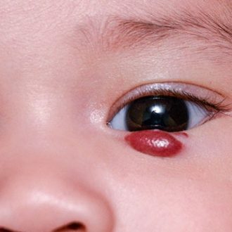 Hemangiomas Treatment Cost in Dubai UAE