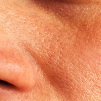 Large Pores Treatment Cost in Dubai & Abu Dhabi