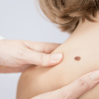 Laser Birthmark Removal Cost in Dubai & Abu Dhabi