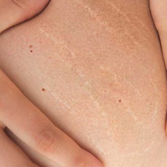 Laser Stretch Marks Removal Cost Dubai & Abu Dhabi