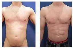 Lipo Chest Surgery Clinic in Abu Dhabi