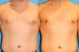 Lipo Chest Surgery Clinic in Dubai