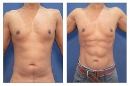 Lipo Chest Surgery in Dubai & Abu Dhabi