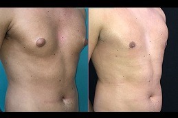 Lipo Chest Surgery in Dubai