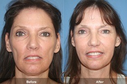 Liquid Facelift Abu Dhabi