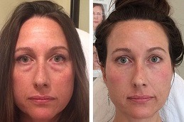 Liquid Facelift Clinic in Abu Dhabi