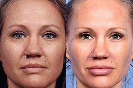 Liquid Facelift Clinic in Dubai