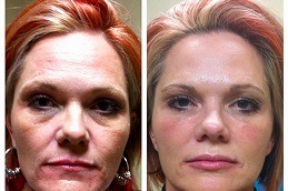 Liquid Facelift in Abu Dhabi