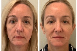 Liquid Facelift in Dubai & Abu Dhabi