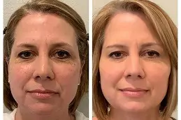 Liquid Facelift in Dubai