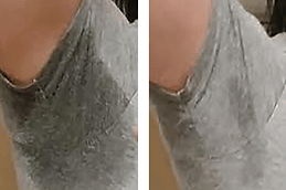 Miradry Treatment in Dubai