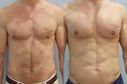 Pectoral Implants Dubai & Abu Dhabi