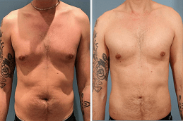 Pectoral Implants in Dubai & Abu Dhabi