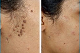 Seborrheic Keratosis Treatment Abu Dhabi