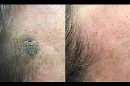 Seborrheic Keratosis Treatment Clinic in Abu Dhabi