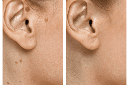 Seborrheic Keratosis Treatment Dubai