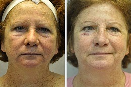 Seborrheic Keratosis Treatment in Abu Dhabi