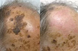 Seborrheic Keratosis Treatment in Dubai