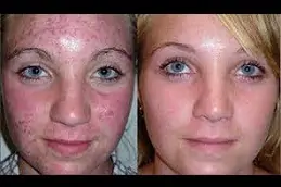 Skin Diseases in Dubai & Abu Dhabi