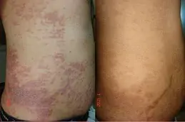 Skin Diseases in Dubai
