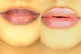 Smoker’s Lips Treatment Cost Dubai & Abu Dhabi