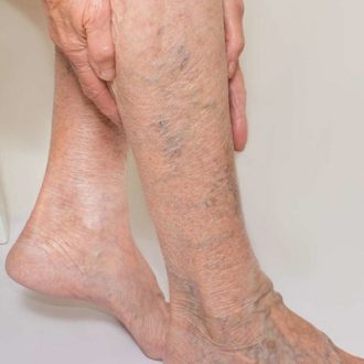Spider Veins Laser Treatment Cost in Dubai