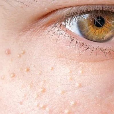 Syringoma Treatment Cost In Dubai, Abu Dhabi & Sharjah | Price