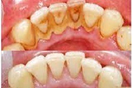 Teeth Polishing & Scaling Clinic Abu Dhabi