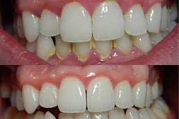 Teeth Polishing & Scaling Dubai