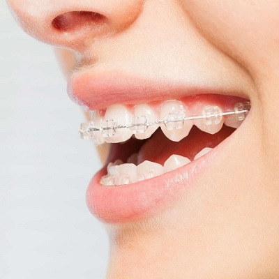 Teeth Straightening and Alignment in Dubai & Abu Dhabi Cost & Price