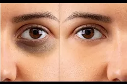 best under-eye-bag-treatment-cost in dubai