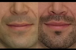 lip-reduction-cost in dubai