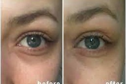 under-eye-bag-treatment-cost Clinic in Dubai