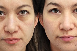 under-eye-bag-treatment-cost in Abu Dhabi