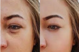 under eye bag treatment cost in dubai