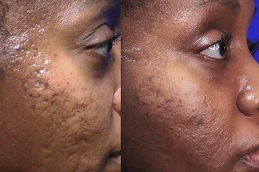 Acne Scar Treatment for Black Skin Dubai