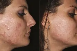 Acne Scar Treatment for Brown Skin Dubai