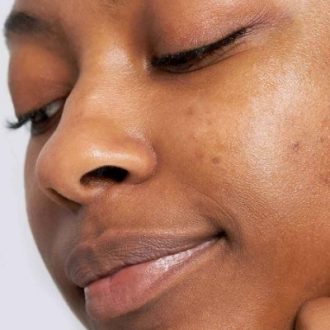 Acne Scar Treatment for Brown Skin in Dubai