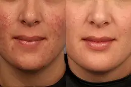 Acne Scar Treatment for Brown Skin in Dubai