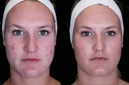 Acne Scar Treatment for Teenagers Dubai