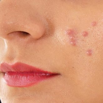 Acne Scar Treatment for Teenagers Dubai