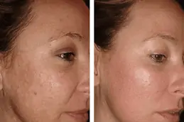 Acne Scar Treatment for Teenagers in Dubai