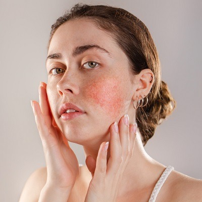 Acne Treatment for Dry Sensitive Skin in Dubai