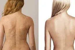 Back Facial Treatment Clinic Dubai & Abu Dhabi