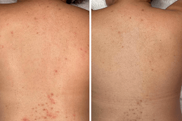 Back Facial Treatment Clinic in Dubai & Abu Dhabi